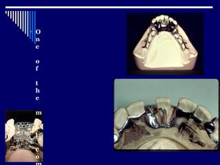 Relining In Rpd RELINING AND REPAIR OF RPD.pptxbhjyuijknbhgyuj | PPTX