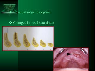  Residual ridge resorption.
 Changes in basal seat tissue
6
 