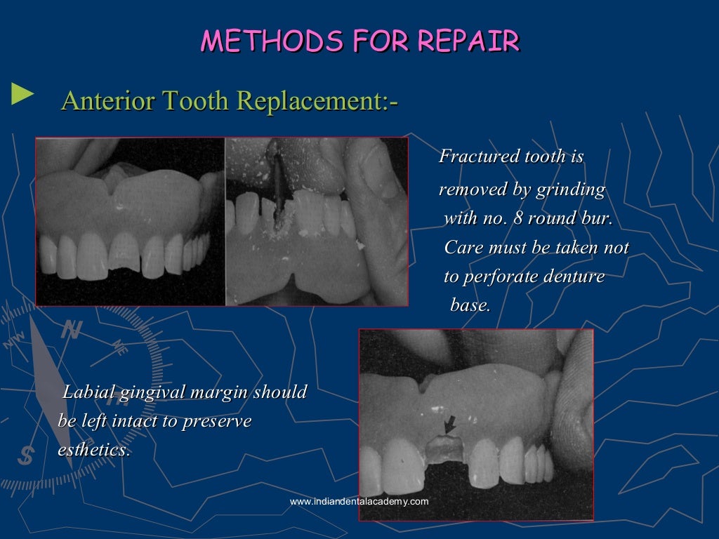 Relining rebasing and repair of complete denture/ dental courses