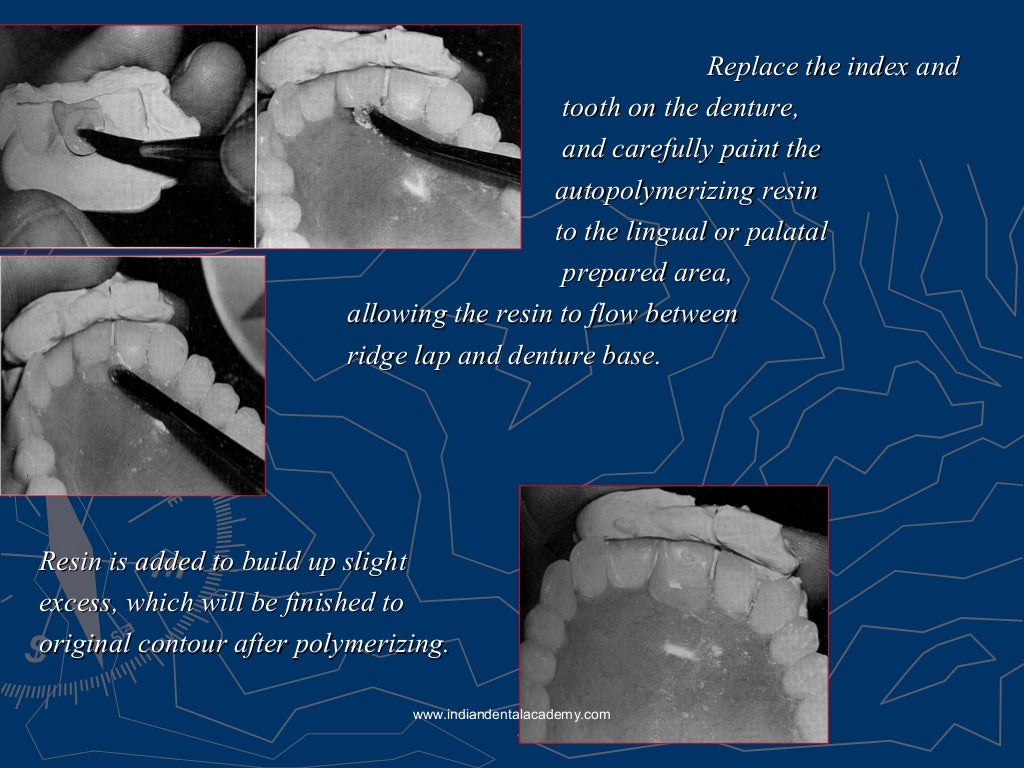 Relining rebasing and repair of complete denture/ dental courses