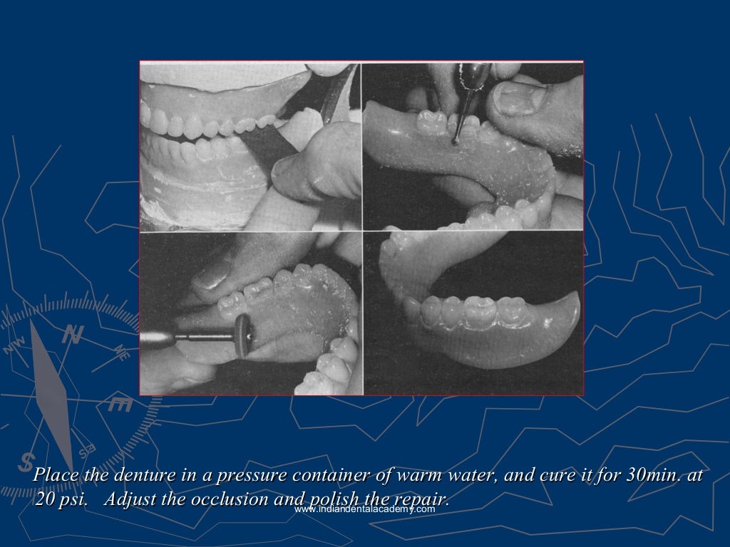 Relining rebasing and repair of complete denture/ dental courses