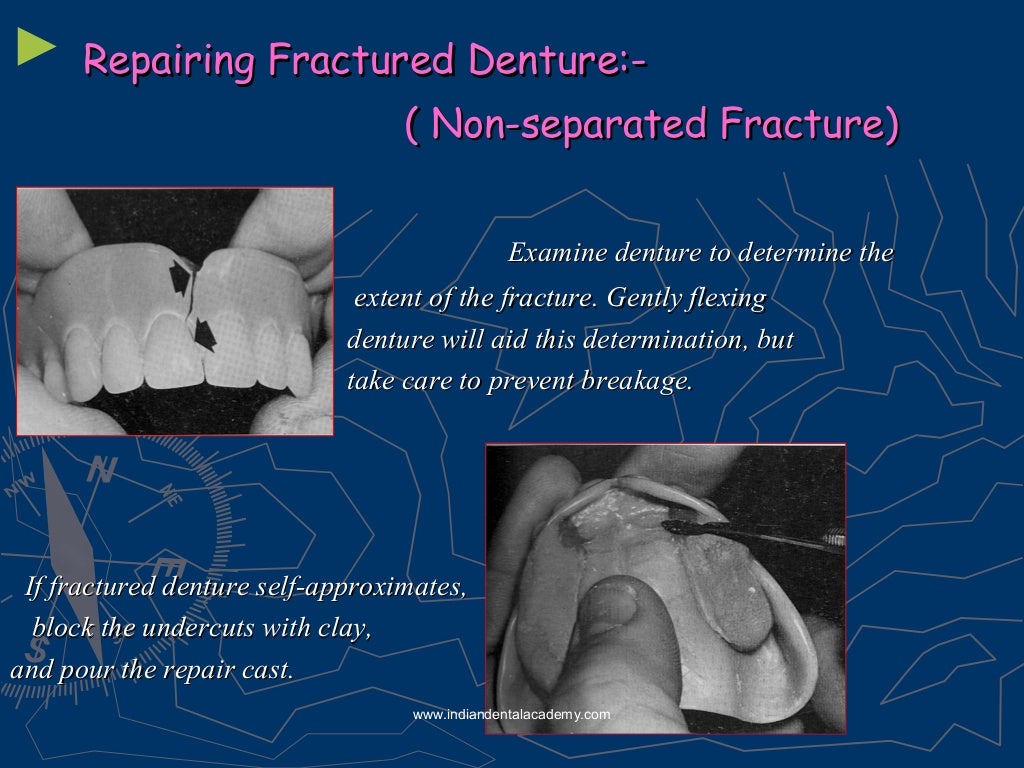 Relining rebasing and repair of complete denture/ dental courses