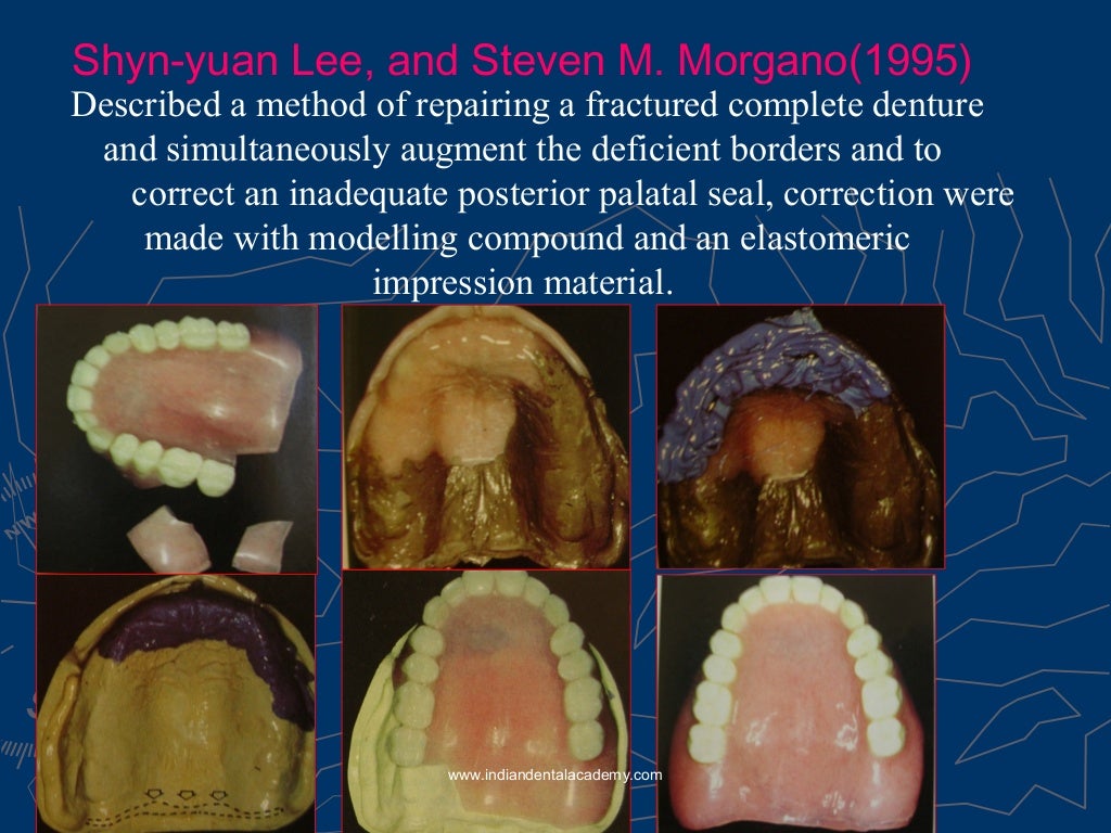 Relining rebasing and repair of complete denture/ dental courses