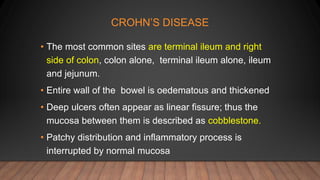 CROHN’S DISEASE
• The most common sites are terminal ileum and right
side of colon, colon alone, terminal ileum alone, ileum
and jejunum.
• Entire wall of the bowel is oedematous and thickened
• Deep ulcers often appear as linear fissure; thus the
mucosa between them is described as cobblestone.
• Patchy distribution and inflammatory process is
interrupted by normal mucosa
 