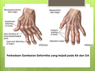 Perbedaan Gambaran Deformitas yang terjadi pada RA dan OA
 