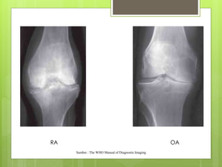 RA OA
Sumber : The WHO Manual of Diagnostic Imaging
 
