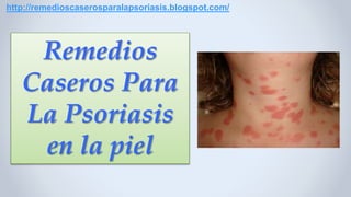 Remedios
Caseros Para
La Psoriasis
en la piel
http://remedioscaserosparalapsoriasis.blogspot.com/
 