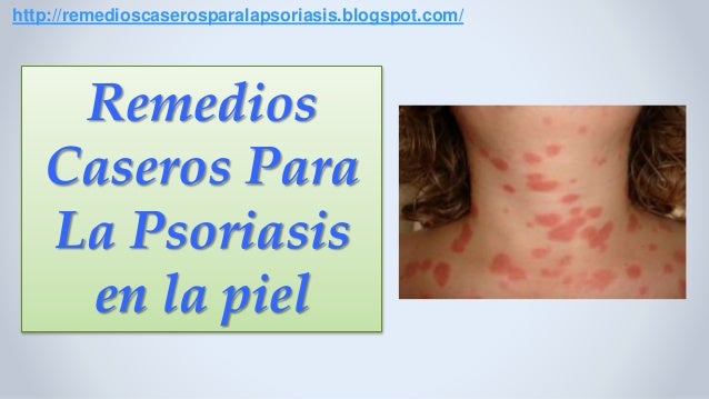 La alopecia y la eccema