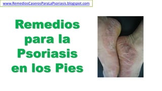 Remedios
para la
Psoriasis
en los Pies
www.RemediosCaserosParaLaPsoriasis.blogspot.com
 