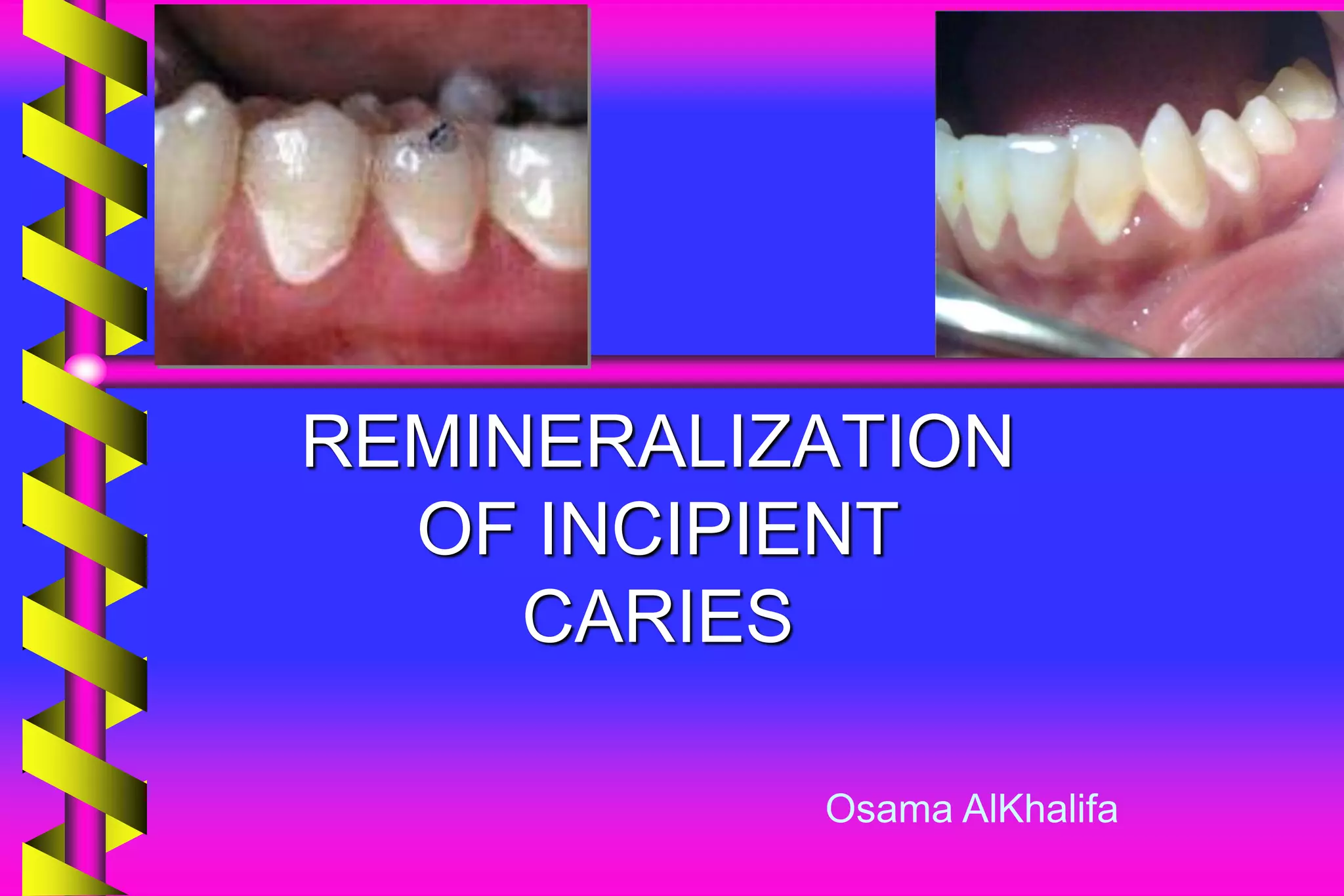 Remineralization 1 PPT