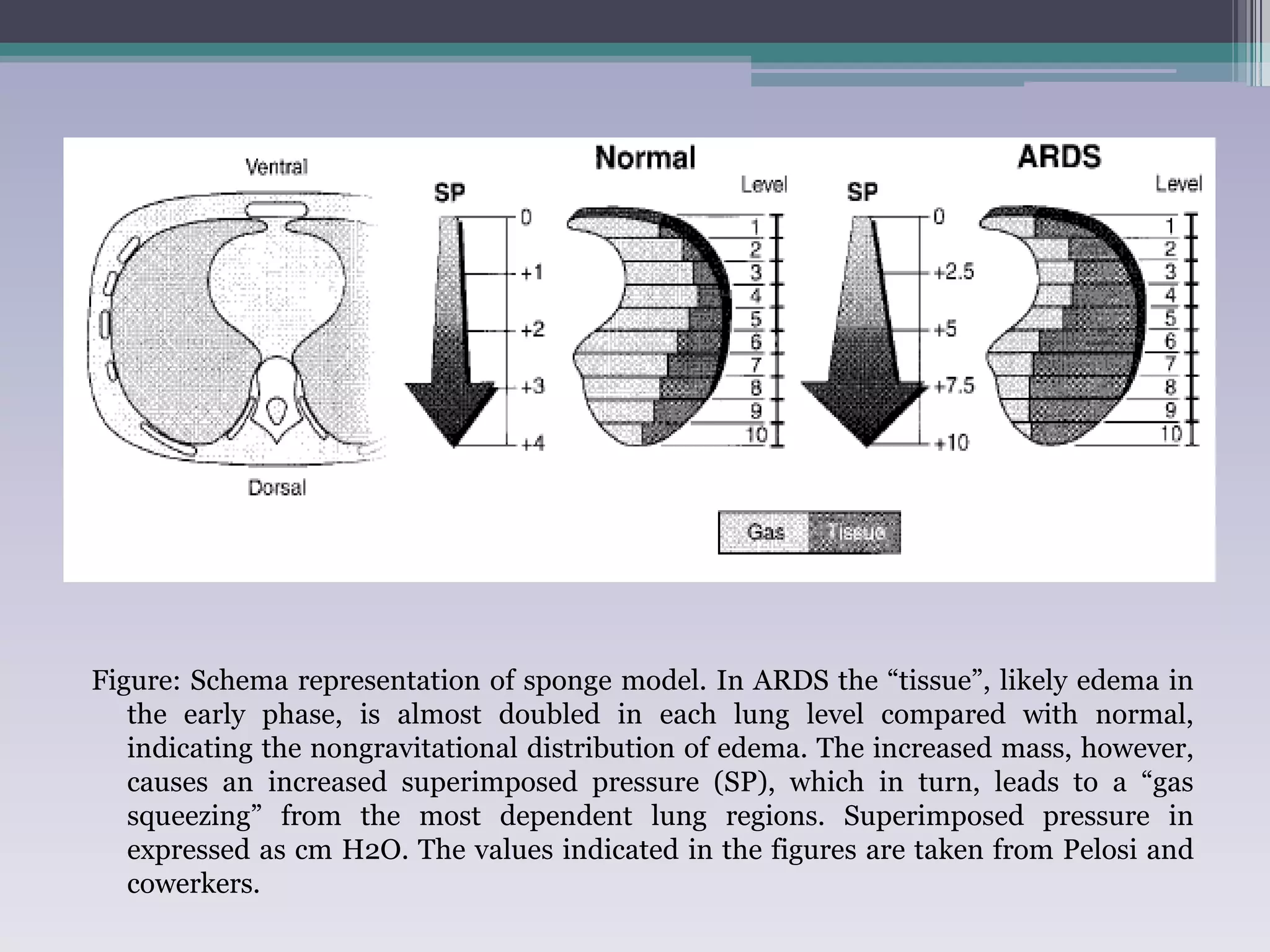 Figure: Schema representation of sponge model. In ARDS the “tissue”, likely edema in 
the early phase, is almost doubled in each lung level compared with normal, 
indicating the nongravitational distribution of edema. The increased mass, however, 
causes an increased superimposed pressure (SP), which in turn, leads to a “gas 
squeezing” from the most dependent lung regions. Superimposed pressure in 
expressed as cm H2O. The values indicated in the figures are taken from Pelosi and 
cowerkers. 
 
