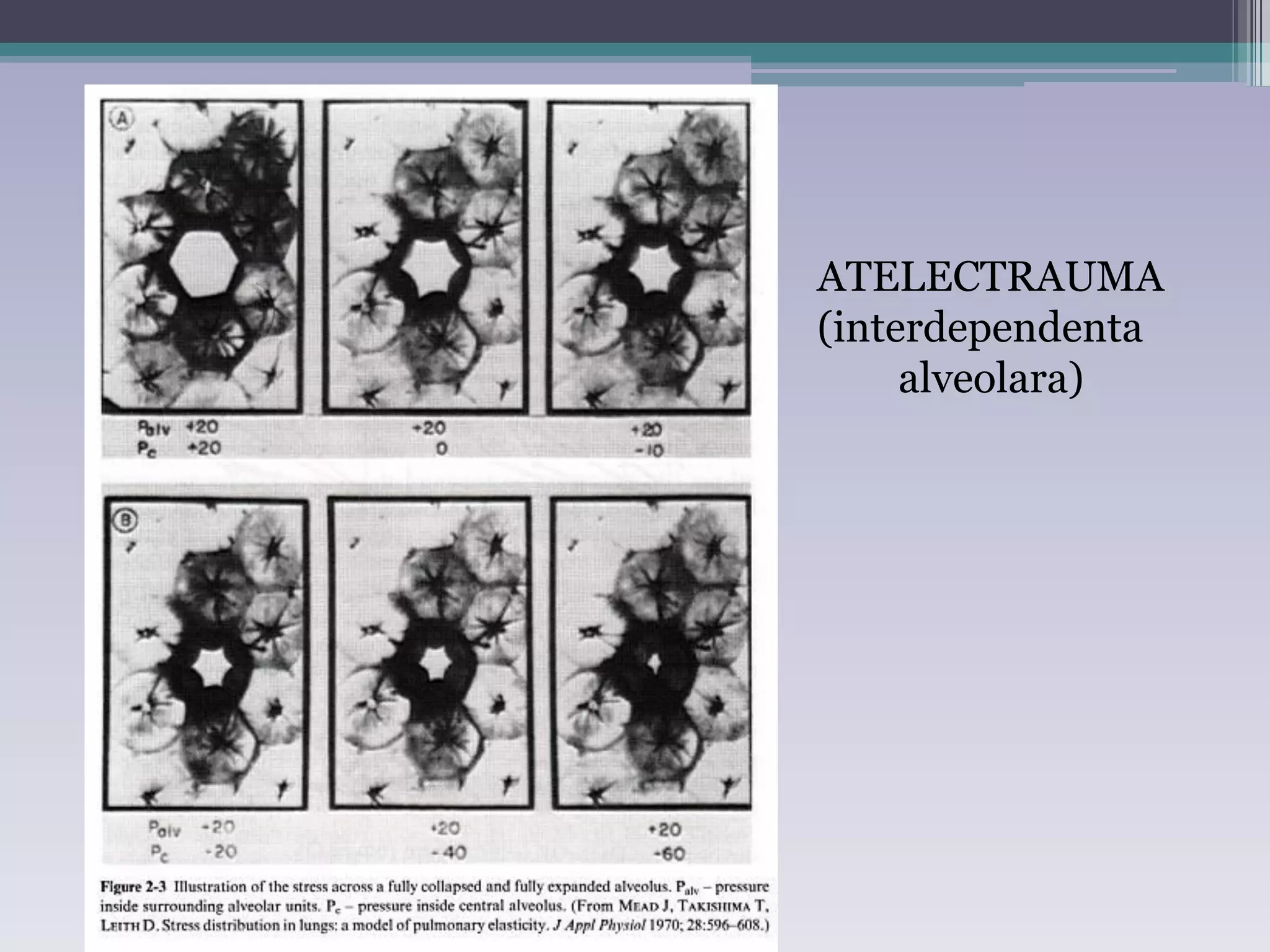 ATELECTRAUMA 
(interdependenta 
alveolara) 
 