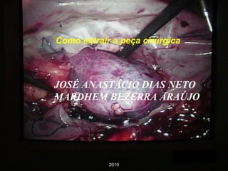 Como extrair a peça cirúrgica JOSÉ ANASTÁCIO DIAS NETO MARDHEM BEZERRA ARAÚJO 2010 