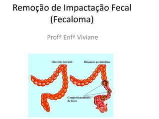 Remoção de Impactação Fecal
(Fecaloma)
Profª Enfª Viviane
 