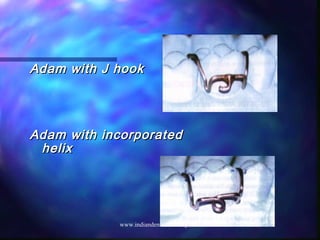 Adam with J hookAdam with J hook
Adam with incorporatedAdam with incorporated
helixhelix
www.indiandentalacademy.com
 