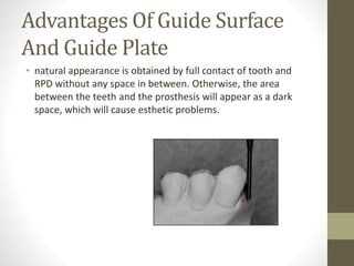 Preparation of the mouth for removable partial denture | PPTX