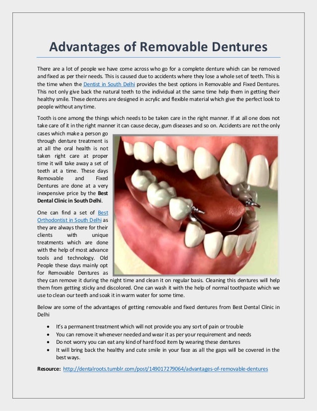 Advantages of Removable Partial Dentures!