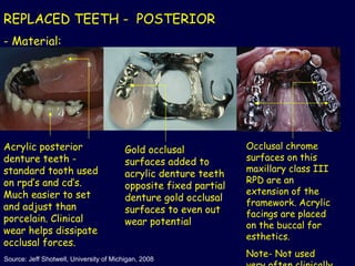 Class 3 Rpd Comprehensive Classification and Components of Removable Partial ...