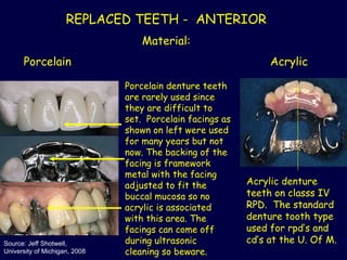 Comprehensive Classification and Components of Removable Partial ...