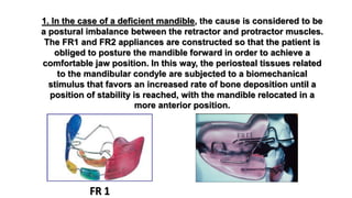 1. In the case of a deficient mandible, the cause is considered to be
a postural imbalance between the retractor and protractor muscles.
The FR1 and FR2 appliances are constructed so that the patient is
obliged to posture the mandible forward in order to achieve a
comfortable jaw position. In this way, the periosteal tissues related
to the mandibular condyle are subjected to a biomechanical
stimulus that favors an increased rate of bone deposition until a
position of stability is reached, with the mandible relocated in a
more anterior position.
 