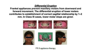 Differential Eruption
Frankel appliances prevent maxillary molars from downward and
forward movement. The differential eruption of lower molars
contributes to establishment of correct sagittal relationship by 1–2
mm. In Class III cases, lower molar stops are given.
 