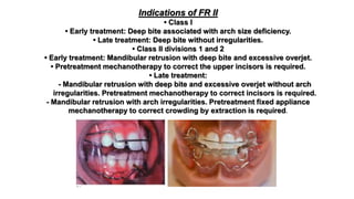 Indications of FR II
• Class I
• Early treatment: Deep bite associated with arch size deficiency.
• Late treatment: Deep bite without irregularities.
• Class II divisions 1 and 2
• Early treatment: Mandibular retrusion with deep bite and excessive overjet.
• Pretreatment mechanotherapy to correct the upper incisors is required.
• Late treatment:
- Mandibular retrusion with deep bite and excessive overjet without arch
irregularities. Pretreatment mechanotherapy to correct incisors is required.
- Mandibular retrusion with arch irregularities. Pretreatment fixed appliance
mechanotherapy to correct crowding by extraction is required.
 