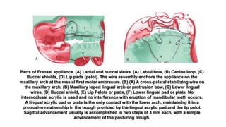 Parts of Frankel appliance. (A) Labial and buccal views. (A) Labial bow, (B) Canine loop, (C)
Buccal shields, (D) Lip pads (pelot). The wire assembly anchors the appliance on the
maxillary arch at the mesial first molar embrasure. (B) (A) A cross-palatal stabilizing wire on
the maxillary arch, (B) Maxillary loped lingual arch or protrusion bow, (C) Lower lingual
wires, (D) Buccal shield, (E) Lip Pelots or pads, (F) Lower lingual pad or plate. No
interocclusal acrylic is used and no interference with eruption of mandibular teeth occurs.
A lingual acrylic pad or plate is the only contact with the lower arch, maintaining it in a
protrusive relationship in the trough provided by the lingual acrylic pad and the lip pelot.
Sagittal advancement usually is accomplished in two steps of 3 mm each, with a simple
advancement of the posturing trough.
 