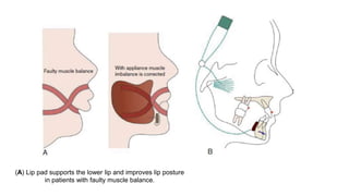 (A) Lip pad supports the lower lip and improves lip posture
in patients with faulty muscle balance.
 