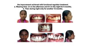 the improvement achieved with functional regulator treatment.
a. Wearing time: 2 h in the afternoon and 6 h in the night for 6 months.
b. Then during night only for another 12 months.
 