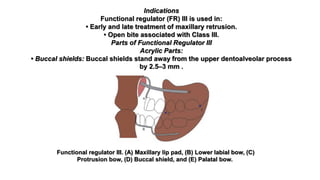 Indications
Functional regulator (FR) III is used in:
• Early and late treatment of maxillary retrusion.
• Open bite associated with Class III.
Parts of Functional Regulator III
Acrylic Parts:
• Buccal shields: Buccal shields stand away from the upper dentoalveolar process
by 2.5–3 mm .
Functional regulator III. (A) Maxillary lip pad, (B) Lower labial bow, (C)
Protrusion bow, (D) Buccal shield, and (E) Palatal bow.
 