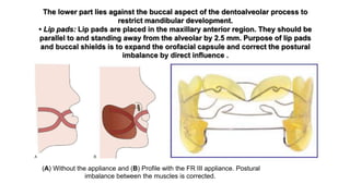 The lower part lies against the buccal aspect of the dentoalveolar process to
restrict mandibular development.
• Lip pads: Lip pads are placed in the maxillary anterior region. They should be
parallel to and standing away from the alveolar by 2.5 mm. Purpose of lip pads
and buccal shields is to expand the orofacial capsule and correct the postural
imbalance by direct influence .
(A) Without the appliance and (B) Profile with the FR III appliance. Postural
imbalance between the muscles is corrected.
 