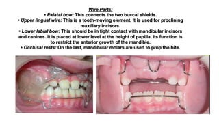 Wire Parts:
• Palatal bow: This connects the two buccal shields.
• Upper lingual wire: This is a tooth-moving element. It is used for proclining
maxillary incisors.
• Lower labial bow: This should be in tight contact with mandibular incisors
and canines. It is placed at lower level at the height of papilla. Its function is
to restrict the anterior growth of the mandible.
• Occlusal rests: On the last, mandibular molars are used to prop the bite.
 