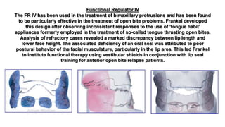 Functional Regulator IV
The FR IV has been used in the treatment of bimaxillary protrusions and has been found
to be particularly effective in the treatment of open bite problems. Frankel developed
this design after observing inconsistent responses to the use of ‘tongue habit’
appliances formerly employed in the treatment of so-called tongue thrusting open bites.
Analysis of refractory cases revealed a marked discrepancy between lip length and
lower face height. The associated deficiency of an oral seal was attributed to poor
postural behavior of the facial musculature, particularly in the lip area. This led Frankel
to institute functional therapy using vestibular shields in conjunction with lip seal
training for anterior open bite relapse patients.
 