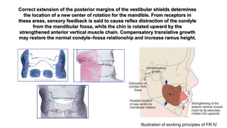 Illustration of working principles of FR IV.
Correct extension of the posterior margins of the vestibular shields determines
the location of a new center of rotation for the mandible. From receptors in
these areas, sensory feedback is said to cause reflex distraction of the condyle
from the mandibular fossa, while the chin is rotated upward by the
strengthened anterior vertical muscle chain. Compensatory translative growth
may restore the normal condyle–fossa relationship and increase ramus height.
 