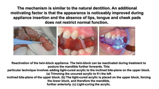 The mechanism is similar to the natural dentition. An additional
motivating factor is that the appearance is noticeably improved during
appliance insertion and the absence of lips, tongue and cheek pads
does not restrict normal function..
Reactivation of the twin-block appliance. The twin-block can be reactivated during treatment to
posture the mandible further forwards. This
particular technique involves adding light-cured acrylic to the inclined bite-plane on the upper block.
(a) Trimming the uncured acrylic to fi t the left
inclined bite-plane of the upper block. (b) The light-cured acrylic is placed on the upper block, forcing
the lower block, and therefore the mandible,
further anteriorly. (c) Light-curing the acrylic.
 
