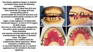 Twin blocks appliance design. A, Anterior
and lateral views show the following
components.
Upper appliance: (1) labial bow (0.8 mm)
from mesial 6&, (2) clasps (0.8 mm)
incorporating coils to
accommodate the Concorde face-bow, and
(3) occlusal inclined planes occlude at a 45”
angle in @
region. Lower appliance: (1) ball-ended
interdental clasps (1 .O mm) in 21112 region,
(2) delta clasps
(0.8 mm) on q (the delta clasp, designed by
the author, gives excellent retention on
lower premolars
and requires minimal adjustment), and (3)
inclined planes in @ region. 8, Occlusal
views. The upper
appliance has a midline screw for
compensatory lateral expansion. Where
necessary, a midline screw
or recurved lingual bow (as in a Jackson
appliance) can be included in the lower
appliance.
 