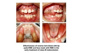 Effectiveness of reverse twin block with lip
pads-RME and face mask with RME in the
early treatment of class III malocclusion
 