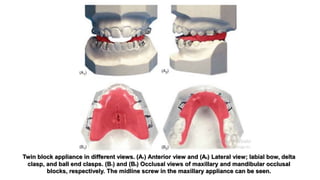 Twin block appliance in different views. (A1) Anterior view and (A2) Lateral view; labial bow, delta
clasp, and ball end clasps. (B1) and (B2) Occlusal views of maxillary and mandibular occlusal
blocks, respectively. The midline screw in the maxillary appliance can be seen.
 