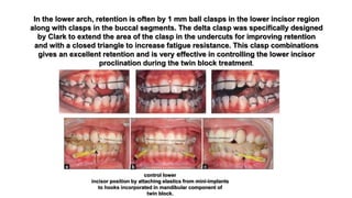 In the lower arch, retention is often by 1 mm ball clasps in the lower incisor region
along with clasps in the buccal segments. The delta clasp was specifically designed
by Clark to extend the area of the clasp in the undercuts for improving retention
and with a closed triangle to increase fatigue resistance. This clasp combinations
gives an excellent retention and is very effective in controlling the lower incisor
proclination during the twin block treatment.
control lower
incisor position by attaching elastics from mini-implants
to hooks incorporated in mandibular component of
twin block.
 
