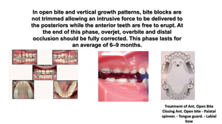 In open bite and vertical growth patterns, bite blocks are
not trimmed allowing an intrusive force to be delivered to
the posteriors while the anterior teeth are free to erupt. At
the end of this phase, overjet, overbite and distal
occlusion should be fully corrected. This phase lasts for
an average of 6–9 months.
Treatment of Ant. Open Bite
Closing Ant. Open bite - Palatal
spinner. - Tongue guard. - Labial
bow
 
