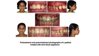 Pretreatment and post-treatment photographs of a patient
treated with twin block appliance.
 