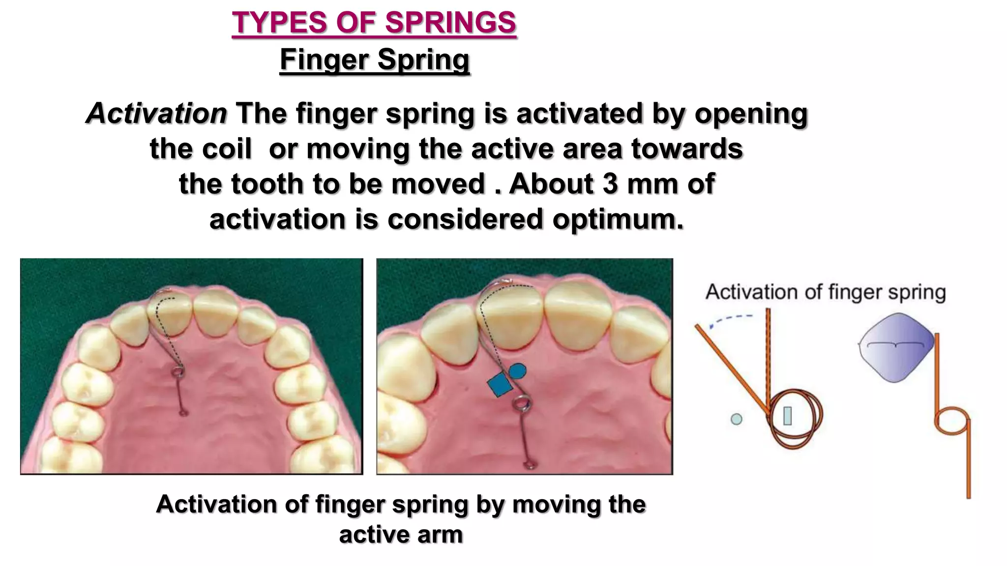 Removable orthodontic appliance | PPTX