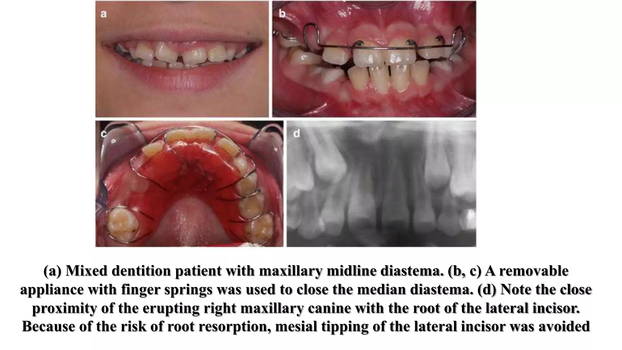 Removable orthodontic appliance | PPTX