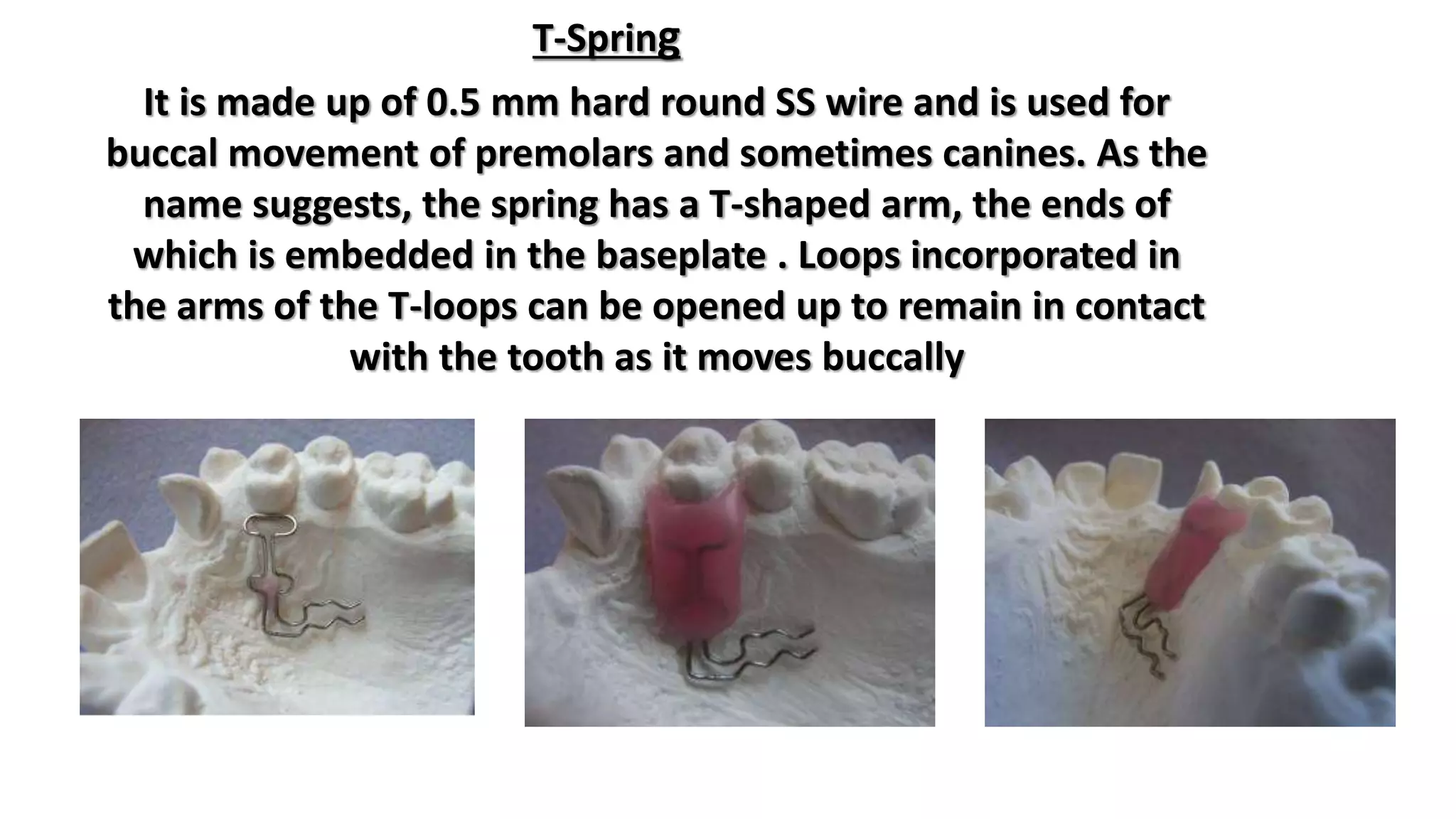 Removable orthodontic appliance | PPTX