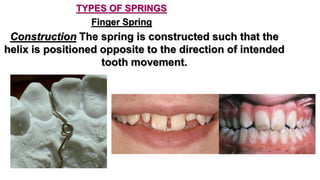 Removable orthodontic appliance | PPTX
