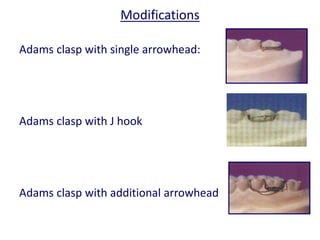 Adams Claps Removable Orthodontic Appliances Analhaq Shaikh | PPTX