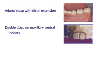 Removable Orthodontic Appliances Analhaq Shaikh | PPTX