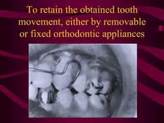 Clinical Adjustment
• Maxillary removable appliances are more tolerable
and successful than the mandibular ones. Because t...