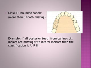  Class III: Bounded saddle
(More than 3 tooth missing).
Example: If all posterior teeth from canines till
molars are missing with lateral incisors then the
classification is AI P III.
 