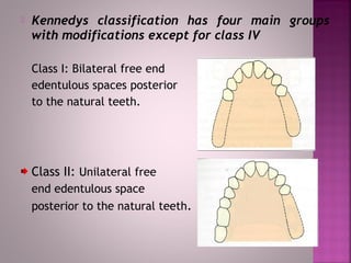 Removable partial denture | PPT